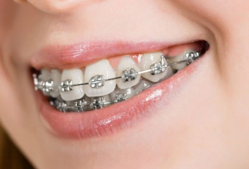 Fixed-Braces
