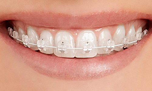 Teeth-EmpowerClear